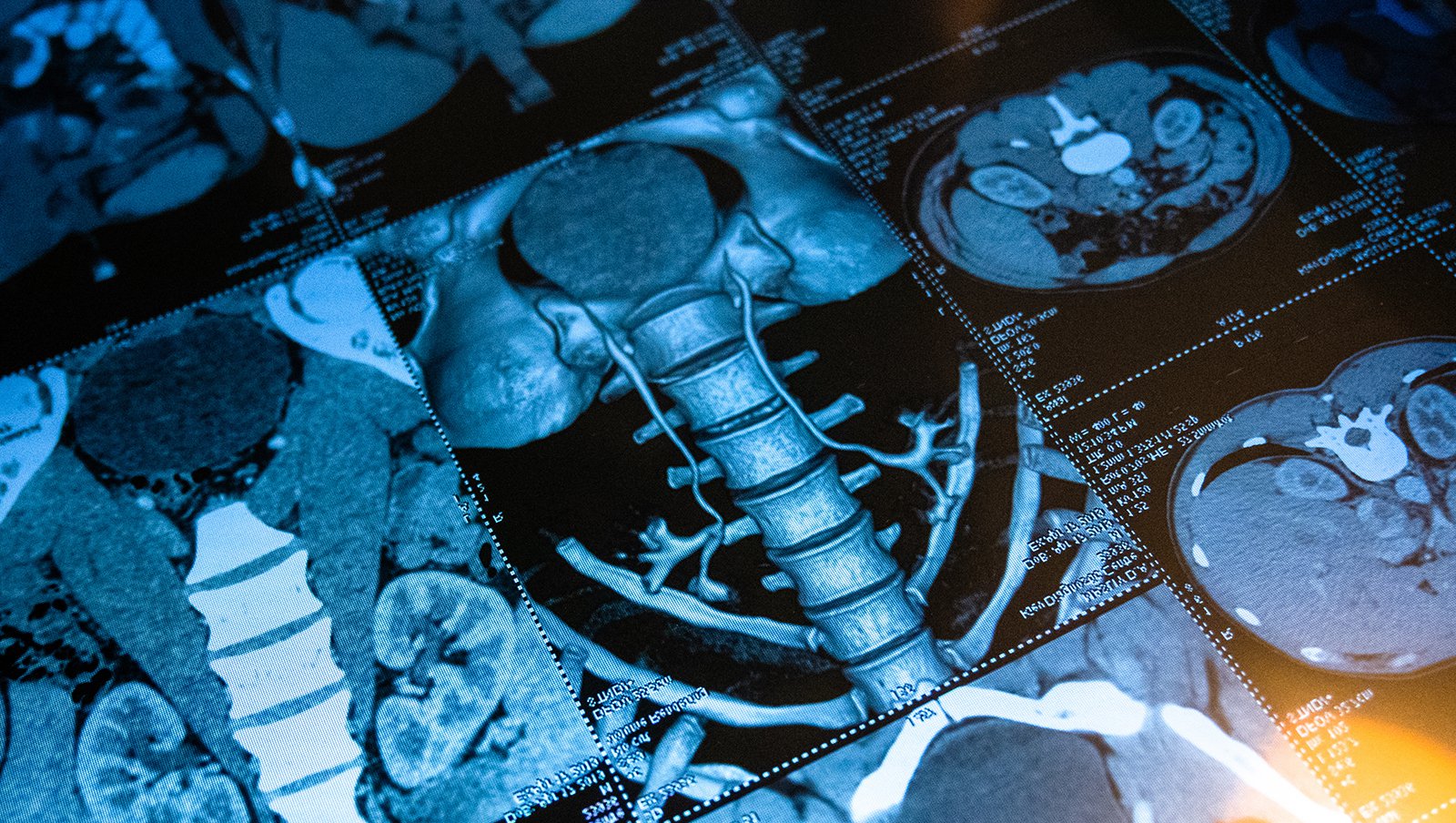 Obrazowanie radiologiczne w stanach nagłych w onkologii dziecięcej (jama brzuszna i miednica mniejsza)