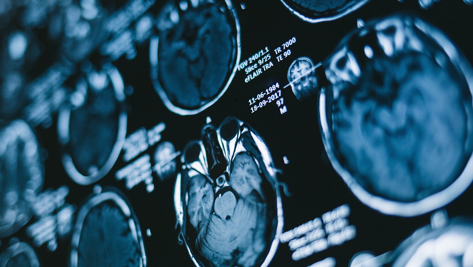 Obrazowanie radiologiczne w stanach nagłych w onkologii dziecięcej (ośrodkowy układ nerwowy)