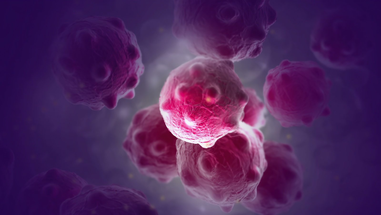 Agresywna neuroblastoma u pacjenta z ciężką hemofilią A