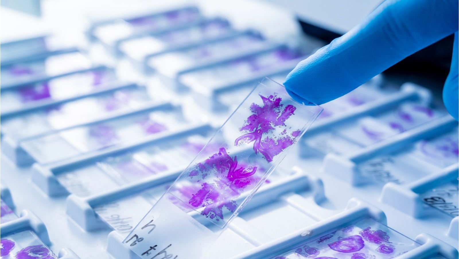 Czy można pominąć biopsję szpiku u pacjentów z mięsakiem prążkowanokomórkowym bez cech zajęcia szpiku w FDG PET?