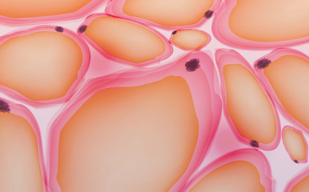 Hipertrójglicerydemia u dzieci z ostrą białaczką limfoblastyczną – terapia skojarzona kwasami omega-3 oraz acipimoksem