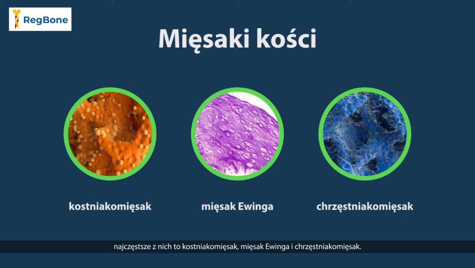 Mięsaki kości u dzieci i młodzieży
