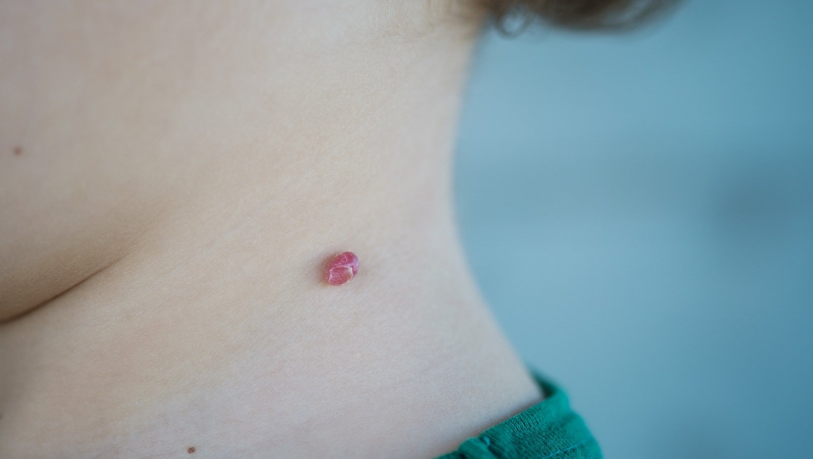 Neurofibromatoza. Nowe ośrodki w opiece koordynowanej dla pacjentów