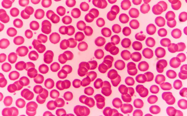 Praktyczne aspekty produktów czynników krzepnięcia o przedłużonym czasie półtrwania (EHL) w leczeniu hemofilii