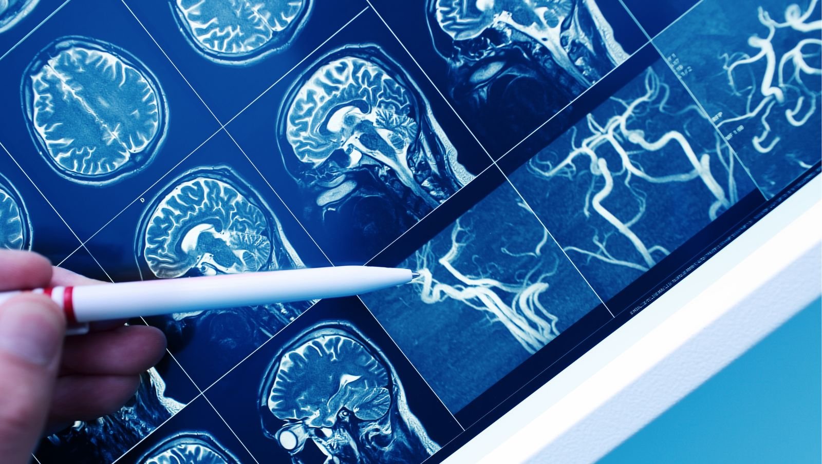 Kliniczna i genetyczna analiza retrospektywna jednoośrodkowa dziecięcych HGG i PNET wg kryteriów WHO CNS5 z 2021 roku