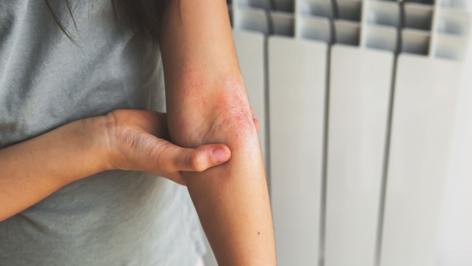 Algorytm postępowania w przypadku objawów dermatotoksyczności skórnej podczas leczenia selumetynibem